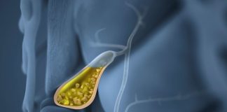 Safra kesesi taşı belirtileri nelerdir? Safra kesesi taşı belirtileri