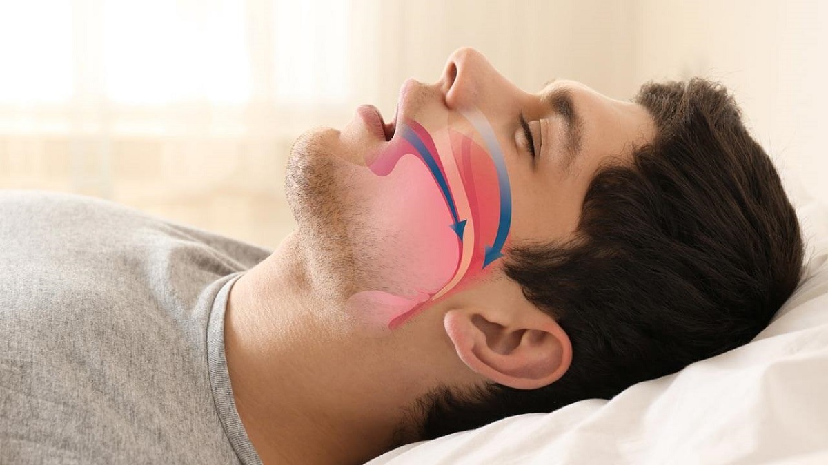 hakkında horlamanin nedenleri Horlama nasıl tedavi edilir