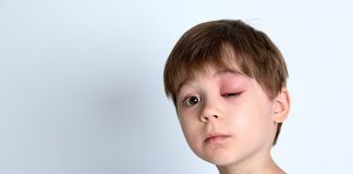 “Her şişlik ve kızarıklık alerji olmayabilir” Herediter Anjioödem